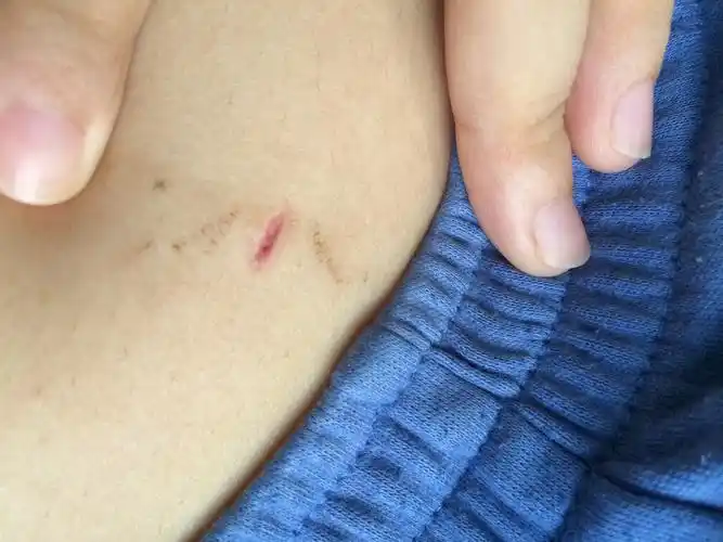 做完阑尾炎手术大半个月了,结痂今天掉了然后长成这样洗澡的时候