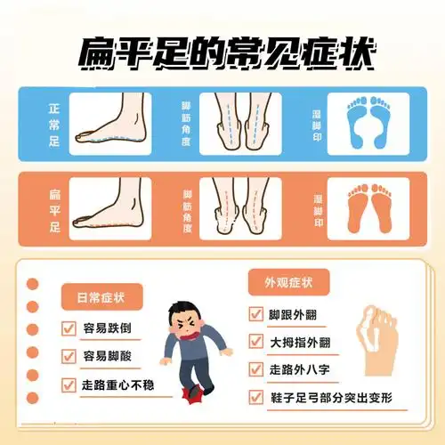 什么是扁平足扁平足有哪些症状表现