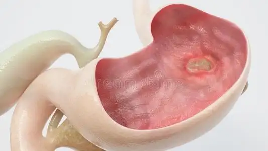 胃溃疡-高的音阶关于详述-3英语字母表中的第四个字母翻译照片