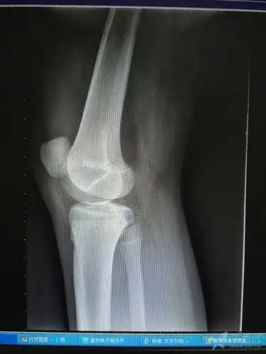 一例儿童髌骨脱位,讨论如何治疗 [病例帖]