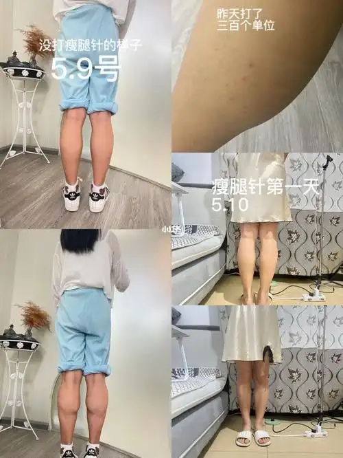 长沙瘦腿针记录反馈