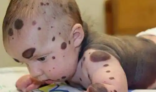 4岁孩子全身大片黑色痣每个月悲痛做手术来治疗