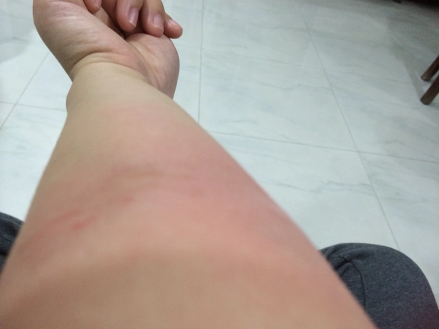 手被烫了怎么办?