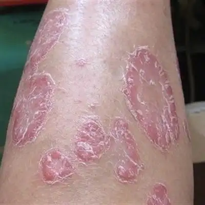 牛皮癣会治疗好吗