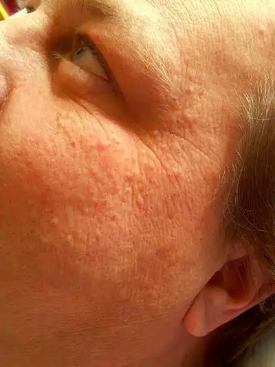 橘皮样皮肤图片45