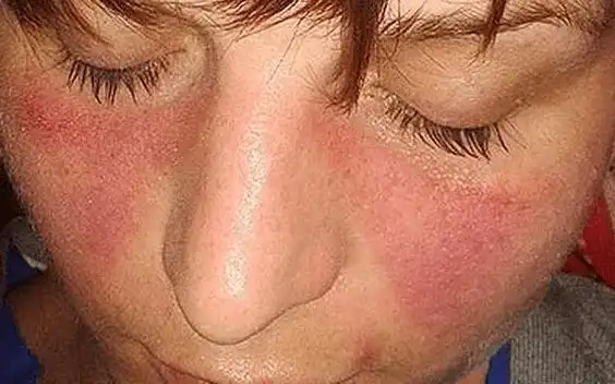 引发全民关注的"红斑狼疮",到底是什么病?为什么"偏爱"女性?