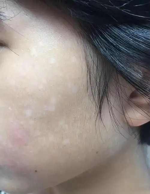 小儿脸上长白斑常见这三种情况_白癜风_白癜风症状表现 - 好大夫在线