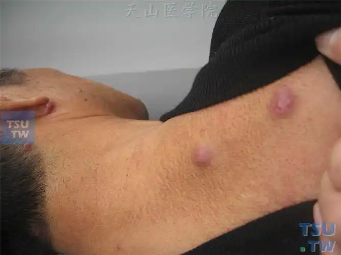 恶性肿瘤:皮肤转移癌的症状表现