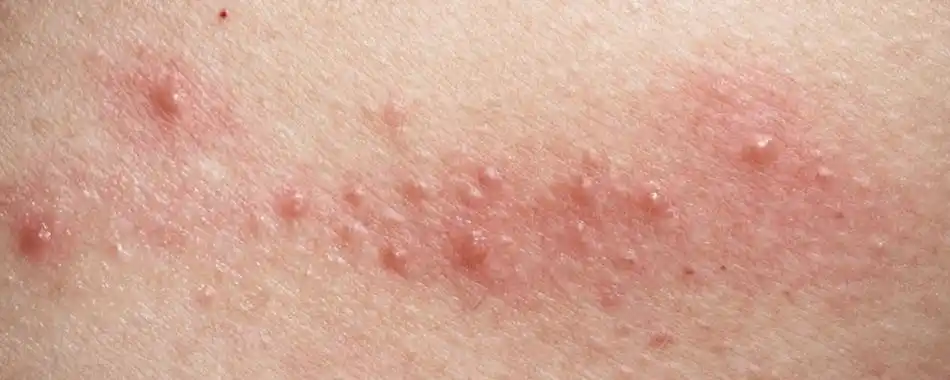 湿疹是因为太"潮",湿气重?医生给了最靠谱的答案