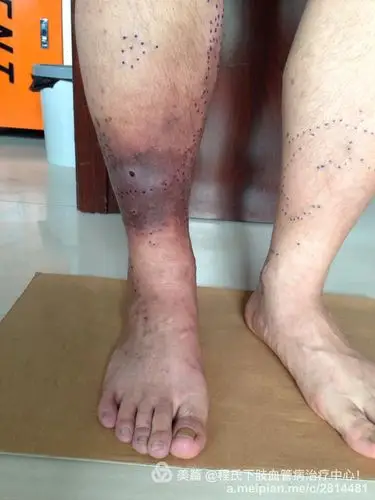 静脉曲张并发血栓性静脉炎老烂腿患者朋友慕名而来我微创治疗中心就诊