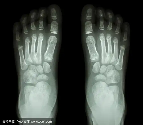 x光检查正常儿童脚部