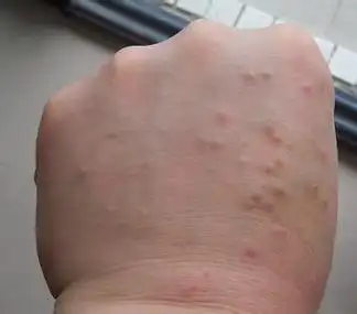 疥疮反反复复瘙痒难忍怎样去除呢