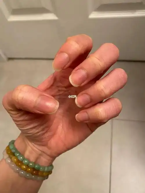 养甲床裸甲一周