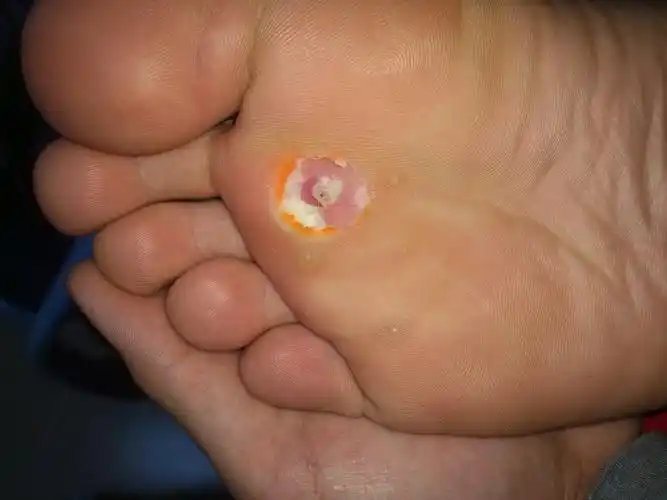 这个是鸡眼还是跖疣