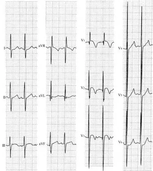第155例 先天性心脏病,室间隔缺损,卵圆孔未闭【心电图分析】 心电图