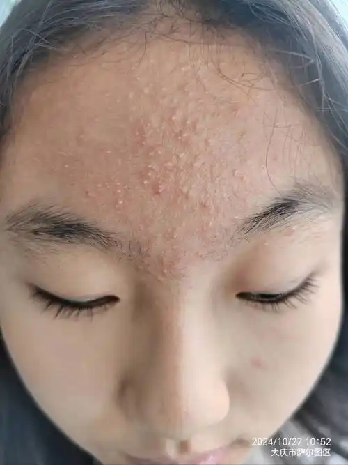 寻常型痤疮