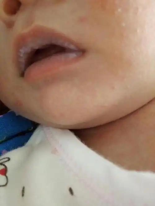 宝宝出生十一天 嘴巴上白白的是什么