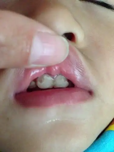 两岁宝宝,这牙齿是怎么回事,坑坑洼洼的