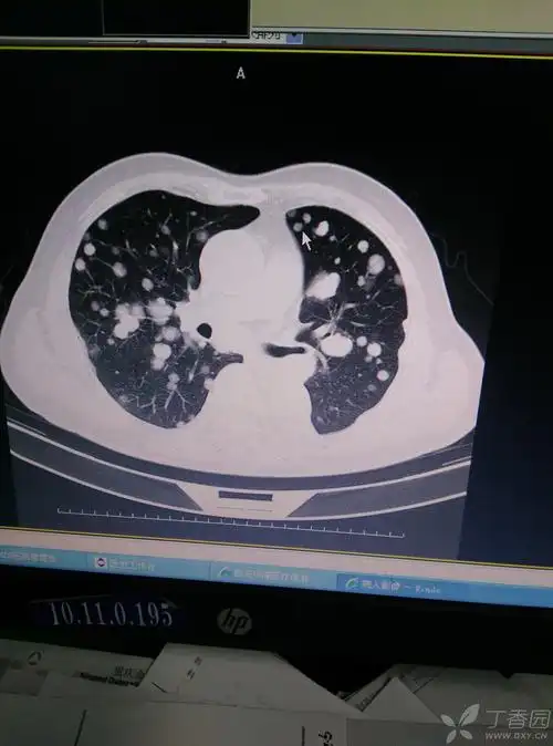 ct肺癌? - 呼吸与胸部疾病讨论版 -丁香园论坛