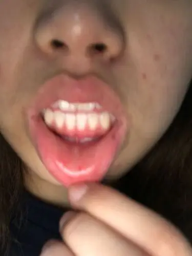 小肉芽,触碰到很痛,平时没感觉,是什么原因引起的,最近唇部内侧有点红