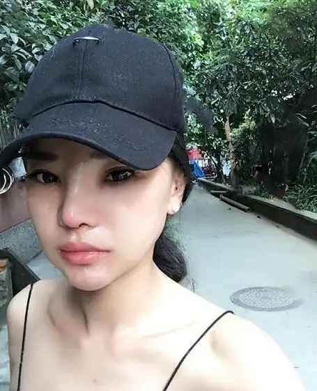 自体软骨隆鼻鼻子翘出了满意的高度