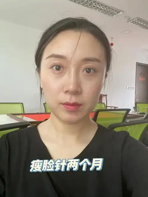 瘦脸针两个月了