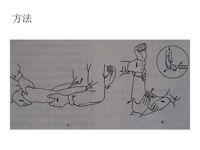 小儿肱骨髁上骨折的复位及治疗技巧