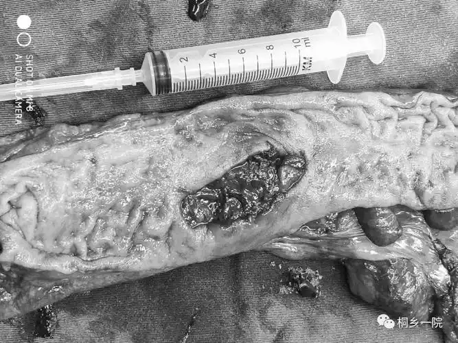 八十老太肠子自发破裂医生都惊呆了