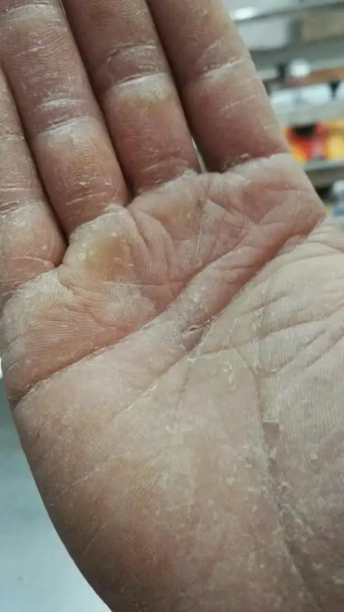 本人做印刷后道加工(覆膜)手好几年了都这样,特别是天气冷,开裂脱皮