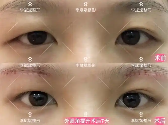 【外眼角提升】外眼角提升案例合集_眼部整形_眼部整形治疗介绍 - 好