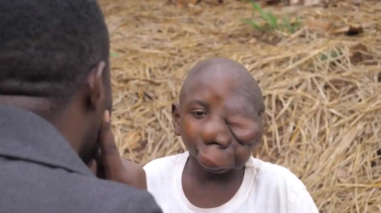 这个男孩因肿瘤导致面部畸形,心生自卑不愿意与外界接触!