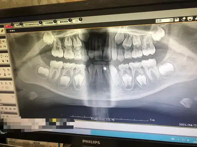 新鲜de乳牙萌发全景