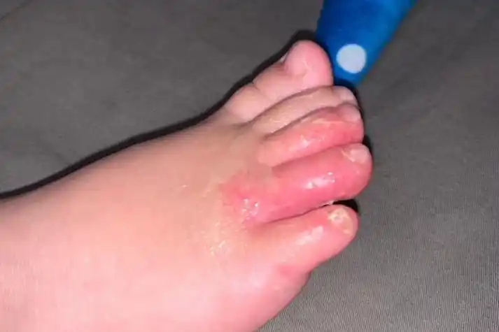 宝宝脚气症状图片