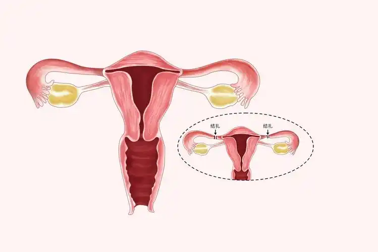 女性的结扎手术一般是通过双侧输卵管结扎阻断精子和卵子的汇合,从而