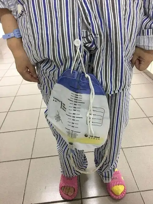 下床活动时,集尿袋的位置不可高于耻骨联合处,可系在病员服最下面一颗