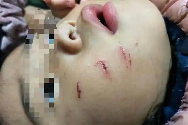 女童幼儿园遭男童咬伤脸部校方孩子之间打闹很正常