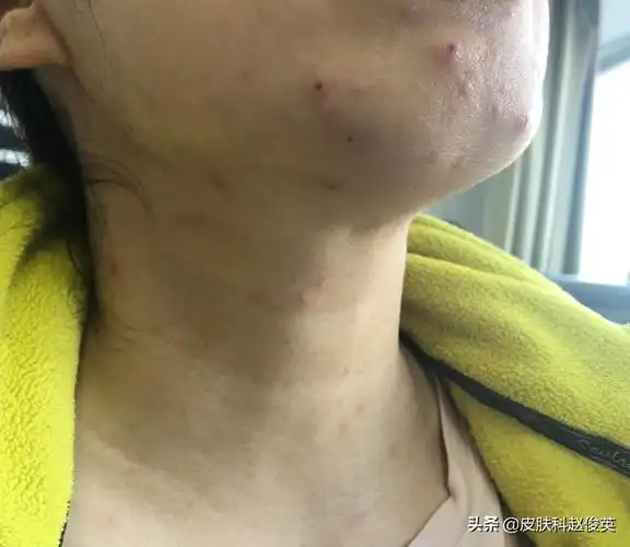 水痘的症状初期会不会痒(大人长水痘的初期症状)-友友