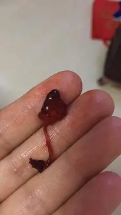 三个多月查处宫颈息肉很大有两个今天收拾家突然掉出来的这是