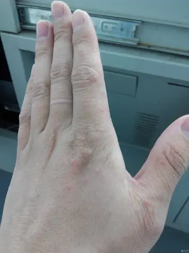 [求助与解答] 不痒,一年出几次,手背上红点