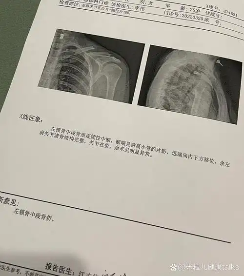 左锁骨骨折 骑电动车 打滑 翻车 锁骨骨折了 好痛 难受 说要立马住院