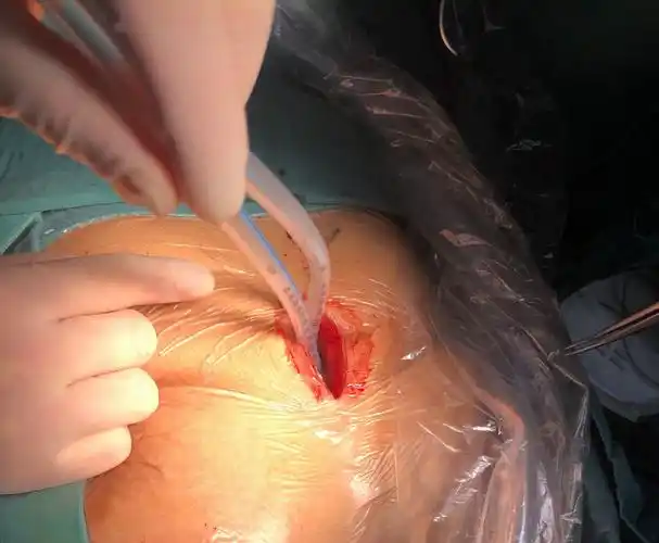 肺部结节_肺部结节缓解方法 - 好大夫在线