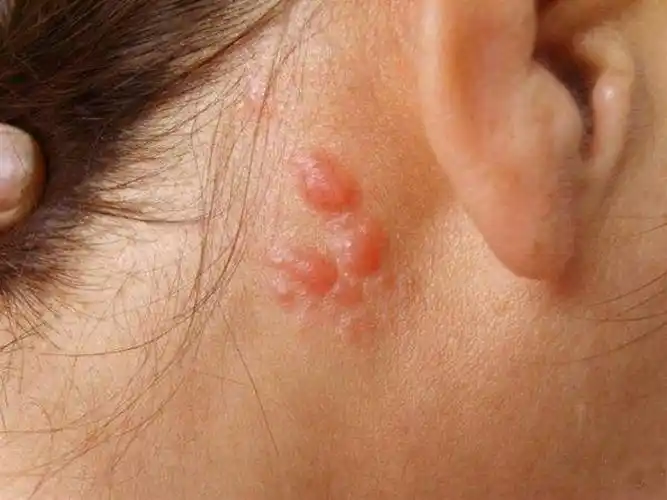 脖子淋巴瘤早期图片_有来医生