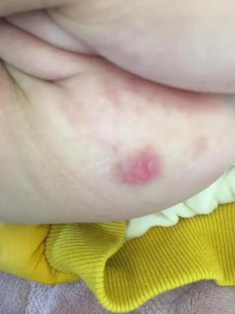 尿布疹皮肤溃烂