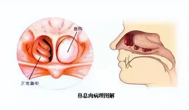 科普知识鼻子里长了鼻息肉该怎么办吗?