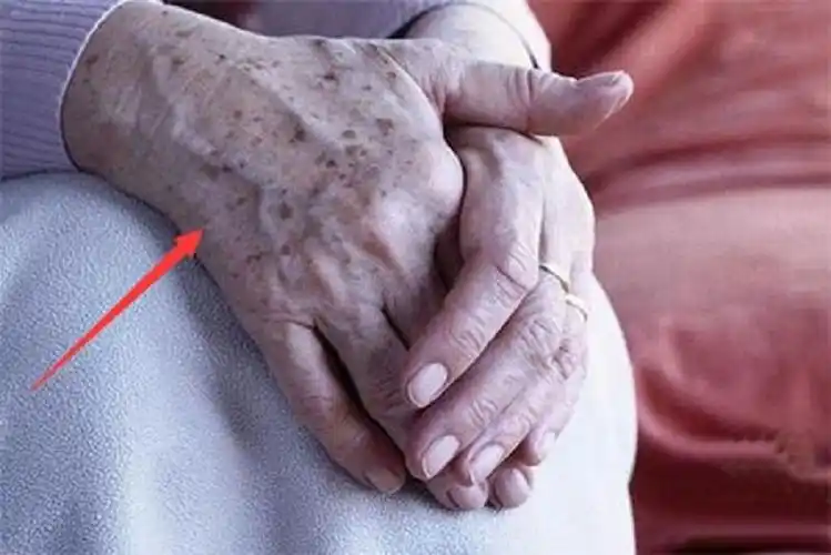 日常高血脂的5个表现为了身体的健康多注意点