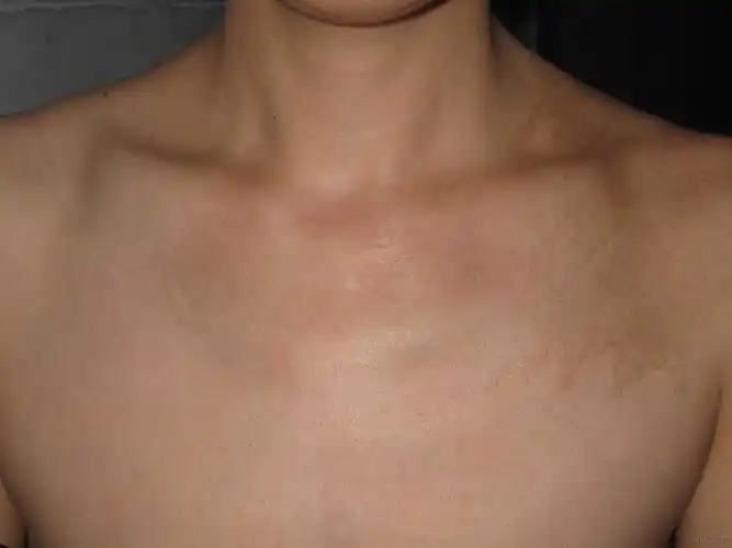 图片分享色素性毛表皮痣