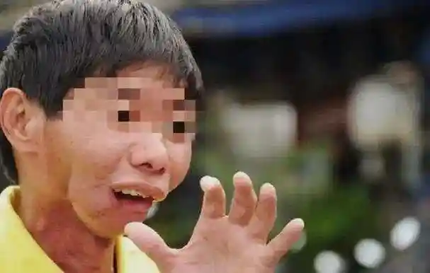 "槟榔四巨头":一天吃5包槟榔,两年死仨,剩下一个割舌保命