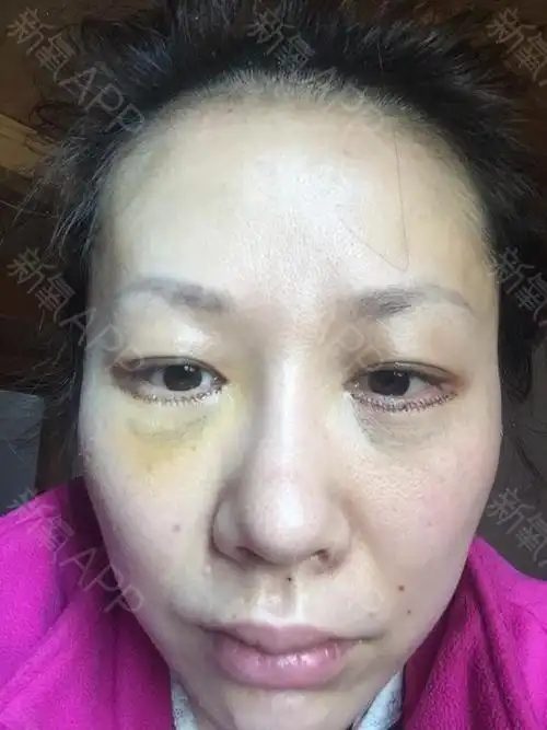 我中意一朵花外切去眼袋第4天美丽日记