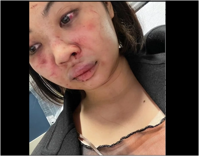 她的脸部淤青肿胀,鼻子附近有凝固的血液,左眼血管破裂