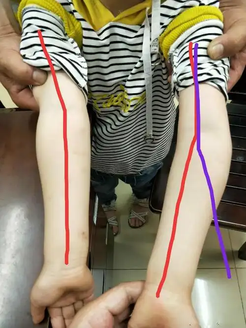 小朋友手臂被车撞变形了似乎另有隐情